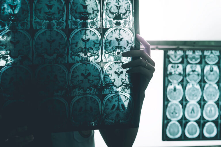 Alzheimer's Disease On MRI Film